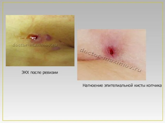 ЭКХ после ревизии Нагноение эпителиальной кисты копчика