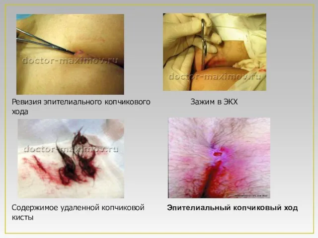 Ревизия эпителиального копчикового хода Зажим в ЭКХ Содержимое удаленной копчиковой кисты Эпителиальный копчиковый ход