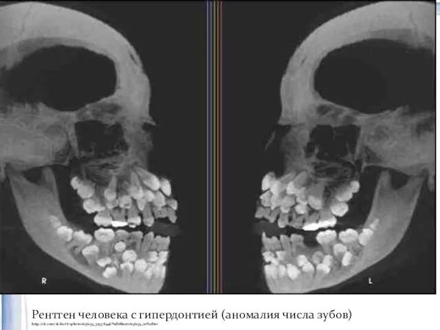 Рентген человека с гипердонтией (аномалия числа зубов) http://vk.com/vk.fact?z=photo-6136139_323378446%2Falbum-6136139_00%2Frev