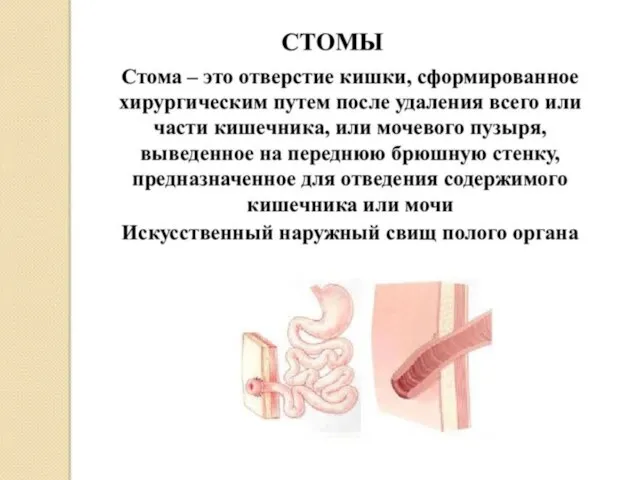 Ещё реже стому накладывают с вспомогательной целью — для проведения лечебных мероприятий,