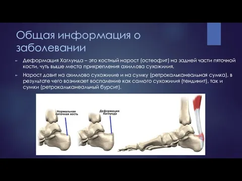 Общая информация о заболевании Деформация Хаглунда – это костный нарост (остеофит) на