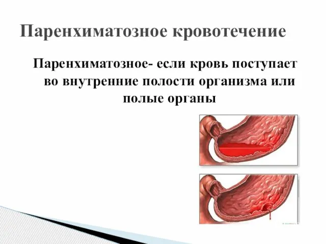 Паренхиматозное кровотечение Паренхиматозное- если кровь поступает во внутренние полости организма или полые органы