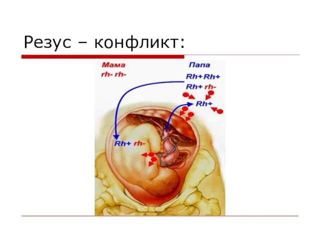 Резус – конфликт: