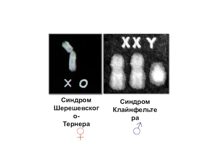 Синдром Шерешевского- Тернера Синдром Клайнфельтера ♂ ♀