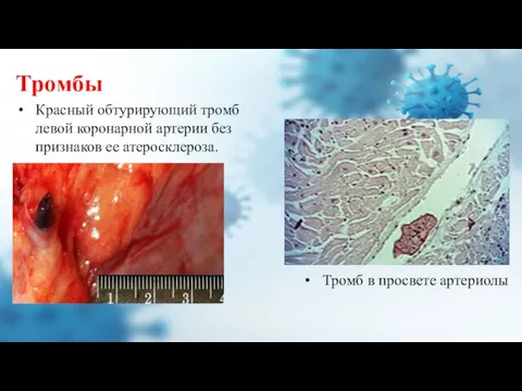 Тромбы Красный обтурирующий тромб левой коронарной артерии без признаков ее атеросклероза. Тромб в просвете артериолы