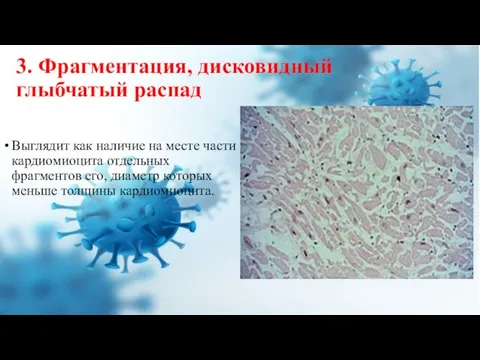 3. Фрагментация, дисковидный глыбчатый распад Выглядит как наличие на месте части кардиомиоцита