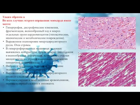 Таким образом в Во всех случаях острого поражения миокарда имеет место: Гипертрофия,