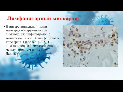 Лимфоцитарный миокардит В интерсти­циальной ткани миокарда обнаруживаются лимфоидные инфильтраты (в количестве более