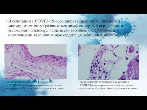 В сочетании с COVID-19-ассоциированным лимфоцитарным миокардитом могут развиваться лимфоцитарный перикардит и эндокардит.