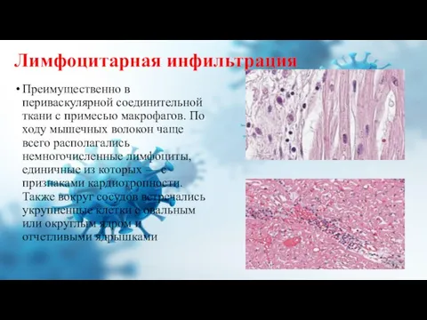 Лимфоцитарная инфильтрация Преимущественно в периваскулярной соединительной ткани с примесью макрофагов. По ходу