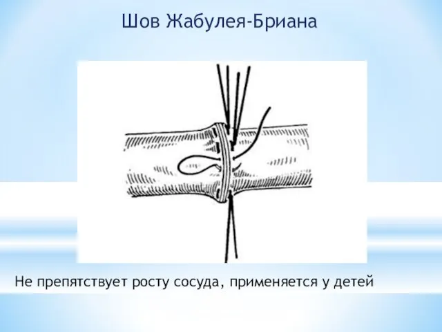 Шов Жабулея-Бриана Не препятствует росту сосуда, применяется у детей