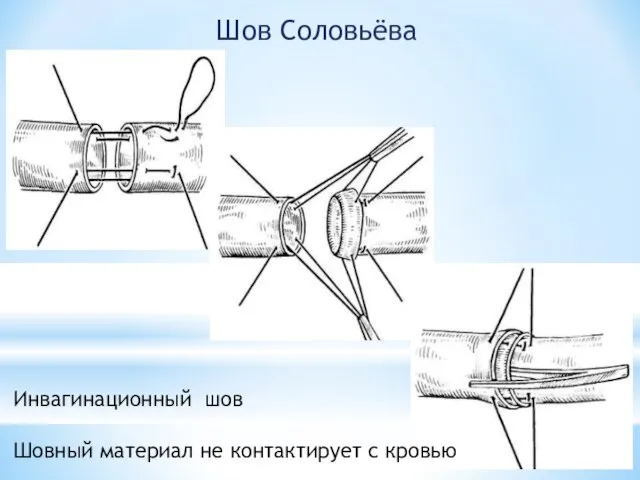 Шов Соловьёва Инвагинационный шов Шовный материал не контактирует с кровью