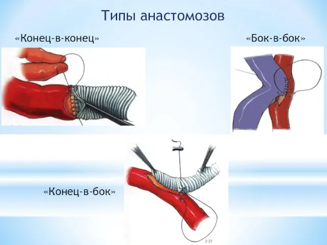 «Конец-в-конец» «Бок-в-бок» «Конец-в-бок» Типы анастомозов