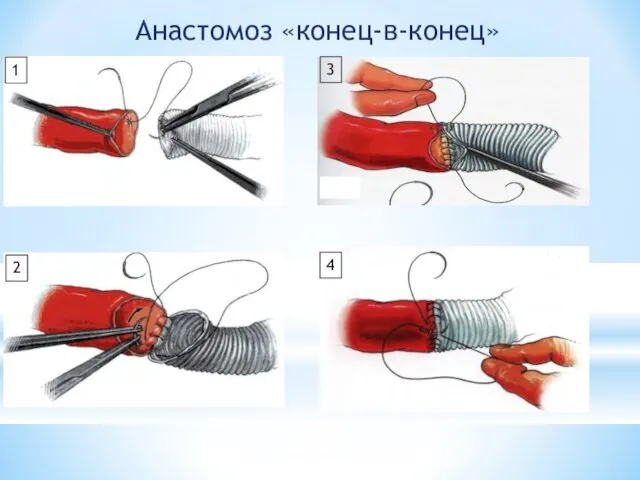 Анастомоз «конец-в-конец» 1 2 3 4