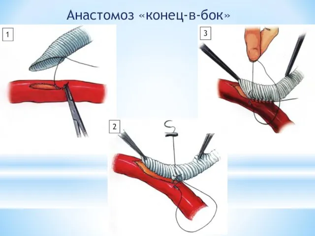 Анастомоз «конец-в-бок» 1 2 3