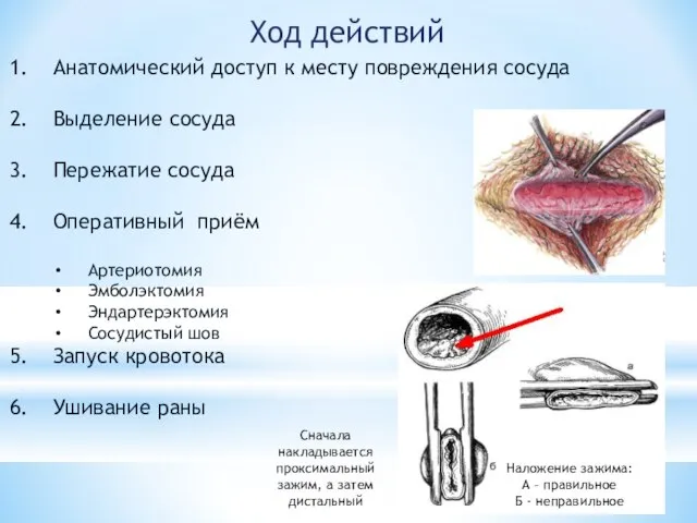 Ход действий Анатомический доступ к месту повреждения сосуда Выделение сосуда Пережатие сосуда