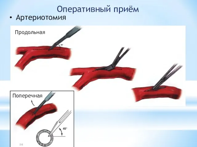 Оперативный приём Артериотомия Продольная Поперечная