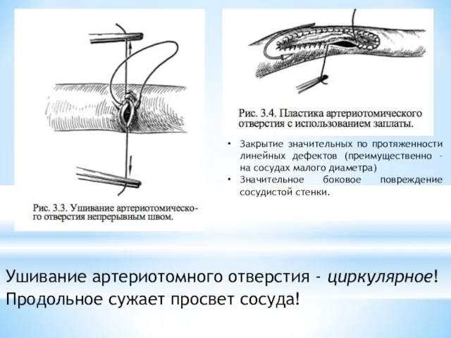 Ушивание артериотомного отверстия - циркулярное! Продольное сужает просвет сосуда! Закрытие значительных по