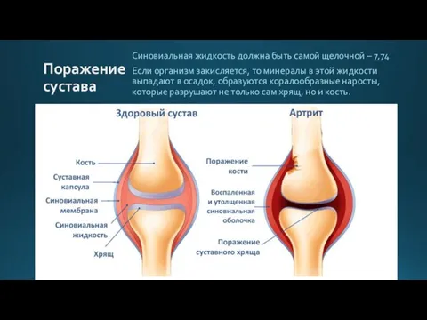 Поражение сустава Синовиальная жидкость должна быть самой щелочной – 7,74 Если организм