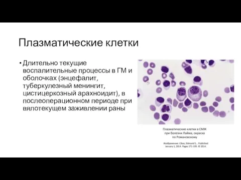 Плазматические клетки Длительно текущие воспалительные процессы в ГМ и оболочках (энцефалит, туберкулезный