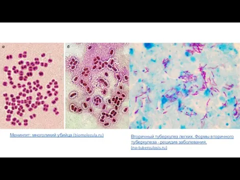 Менингит: многоликий убийца (biomolecula.ru) Вторичный туберкулез легких. Формы вторичного туберкулеза - рецидив заболевания. (no-tuberculosis.ru)