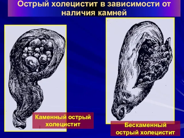 Острый холецистит в зависимости от наличия камней Каменный острый холецистит Бескаменный острый холецистит