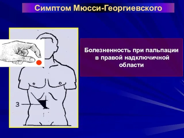 Симптом Мюсси-Георгиевского Болезненность при пальпации в правой надключичной области