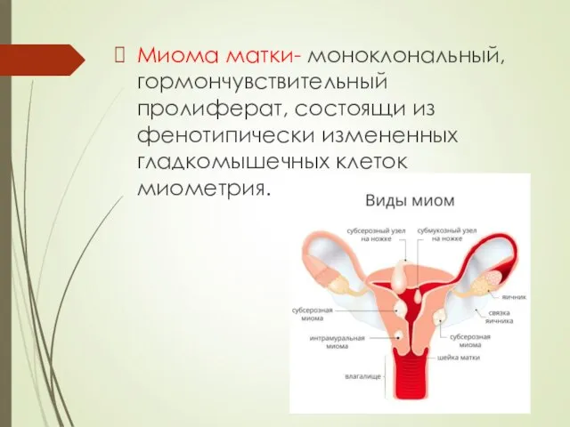 Миома матки- моноклональный, гормончувствительный пролиферат, состоящи из фенотипически измененных гладкомышечных клеток миометрия.