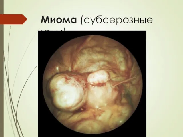 Миома (субсерозные узлы) лапароскопия
