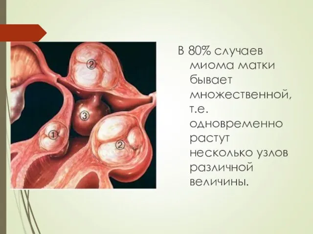 В 80% случаев миома матки бывает множественной, т.е. одновременно растут несколько узлов различной величины.