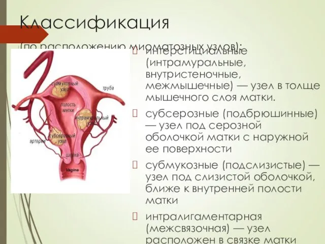 Классификация (по расположению миоматозных узлов): интерстициальные (интрамуральные, внутристеночные, межмышечные) — узел в