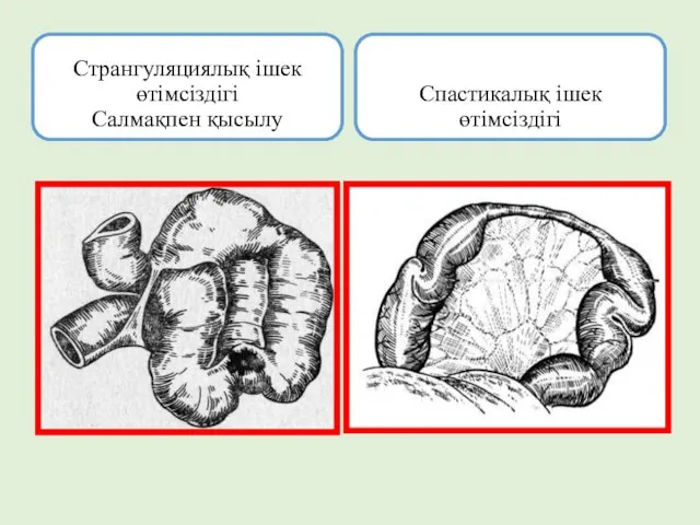 Странгуляциялық ішек өтімсіздігі Салмақпен қысылу Спастикалық ішек өтімсіздігі