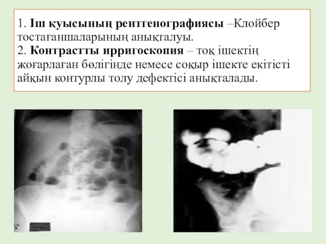 1. Іш қуысының рентгенографиясы –Клойбер тостағаншаларының анықталуы. 2. Контрастты ирригоскопия – тоқ