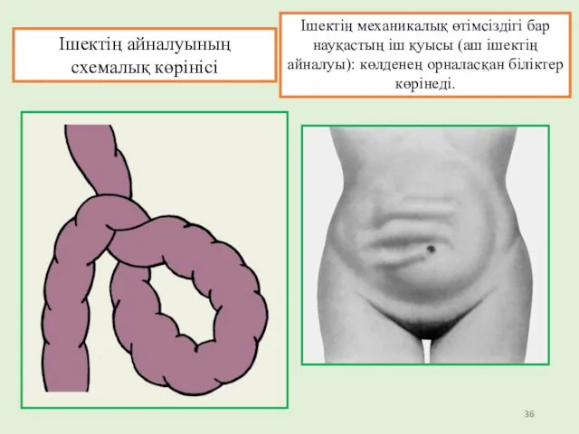 Ішектің айналуының схемалық көрінісі Ішектің механикалық өтімсіздігі бар науқастың іш қуысы (аш