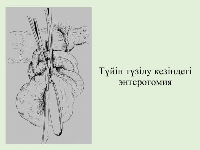 Түйін түзілу кезіндегі энтеротомия