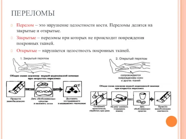 ПЕРЕЛОМЫ Перелом – это нарушение целостности кости. Переломы делятся на закрытые и