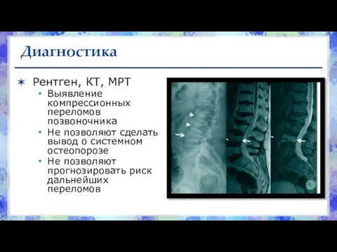 Диагностика Рентген, КТ, МРТ Выявление компрессионных переломов позвоночника Не позволяют сделать вывод