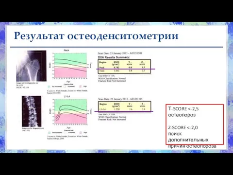 Результат остеоденситометрии Т-SCORE Z-SCORE