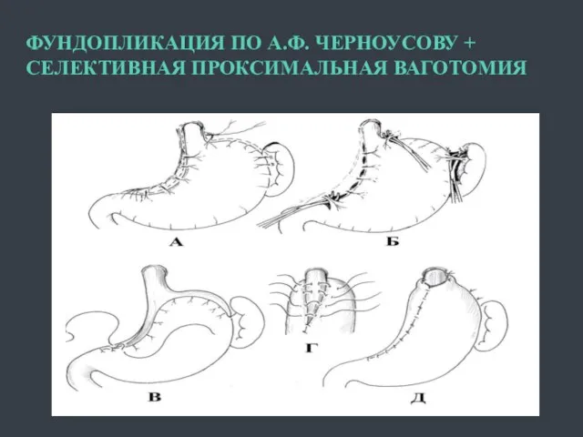 ФУНДОПЛИКАЦИЯ ПО А.Ф. ЧЕРНОУСОВУ + СЕЛЕКТИВНАЯ ПРОКСИМАЛЬНАЯ ВАГОТОМИЯ