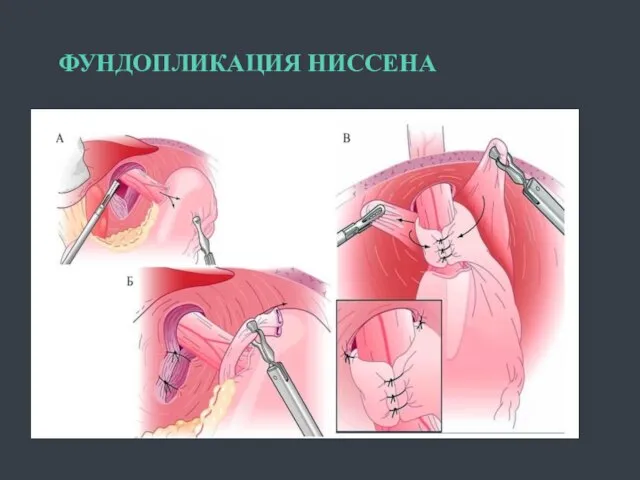 ФУНДОПЛИКАЦИЯ НИССЕНА