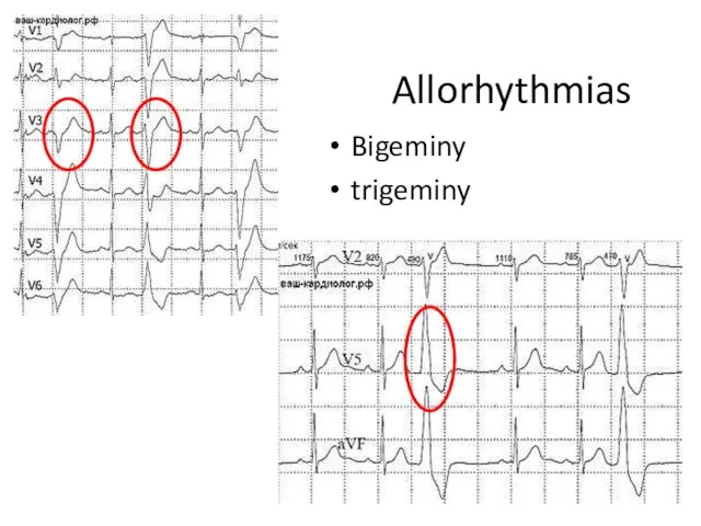 Allorhythmias Bigeminy trigeminy