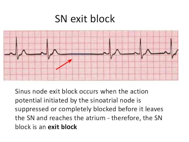 Sinus node exit block occurs when the action potential initiated by the