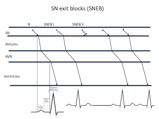 SN exit blocks (SNEB)