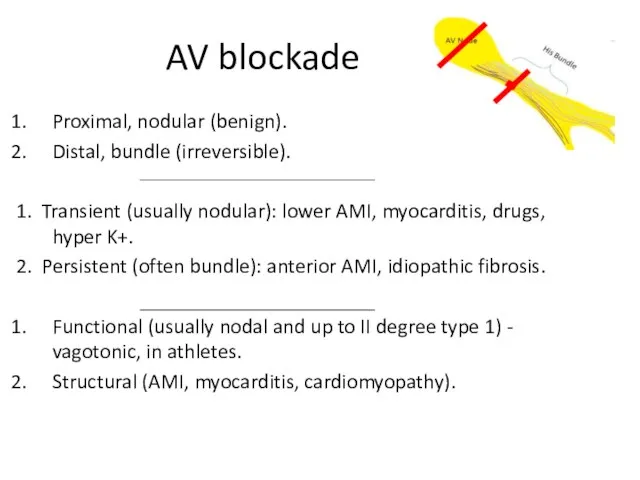 AV blockade Proximal, nodular (benign). Distal, bundle (irreversible). 1. Transient (usually nodular):