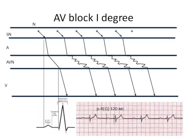 AV block I degree