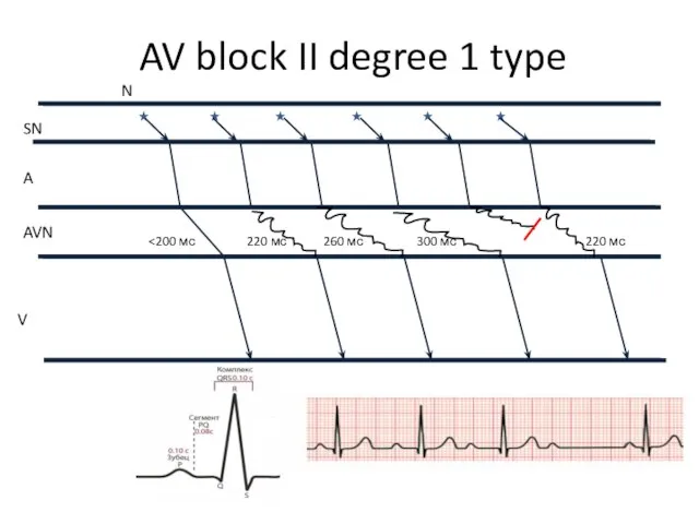AV block II degree 1 type