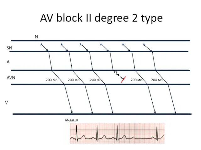 200 мс AV block II degree 2 type