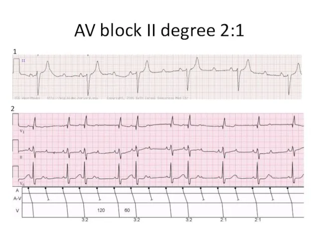AV block II degree 2:1 1 2