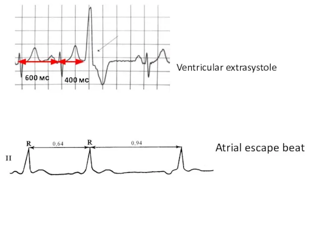 400 мс Atrial escape beat Ventricular extrasystole 600 мс