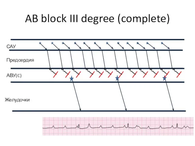 AB block III degree (complete)